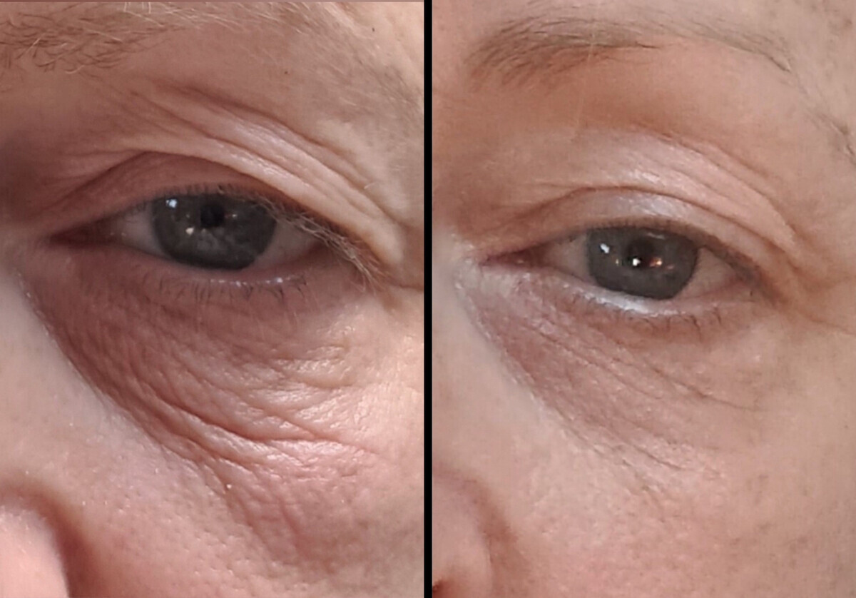 Sofwave before and after — patient example 7