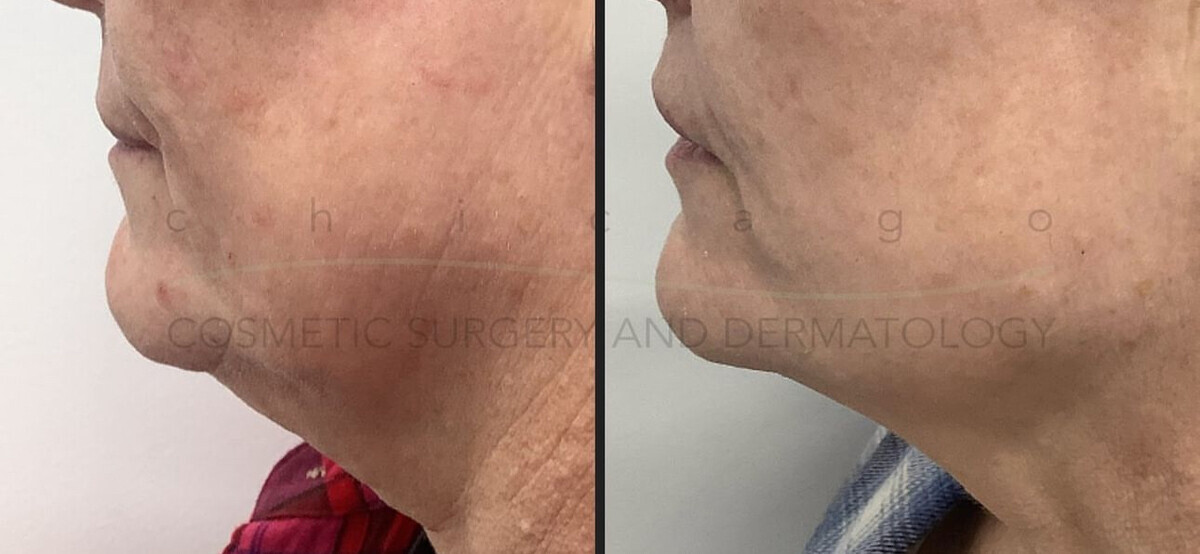 Sofwave before and after — patient example 6