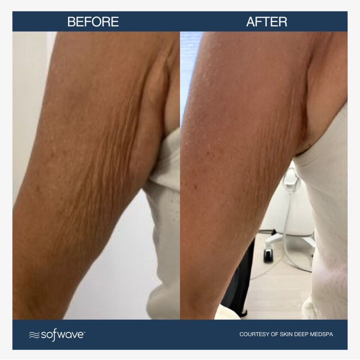 Sofwave before and after — patient example 5