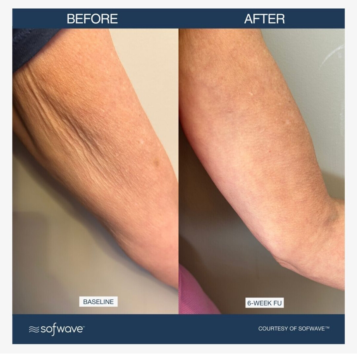 Sofwave before and after — patient example 4