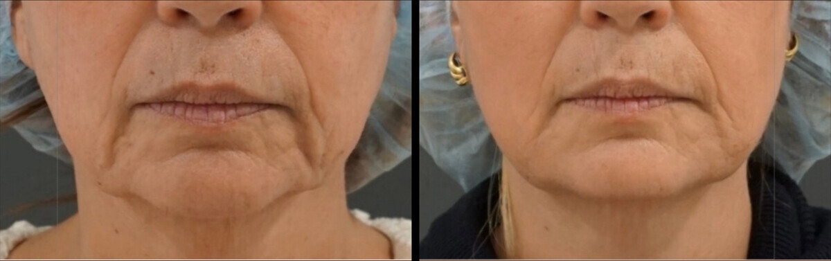 Sofwave before and after — patient example 3