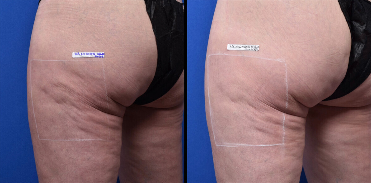 Sofwave before and after — patient example 2