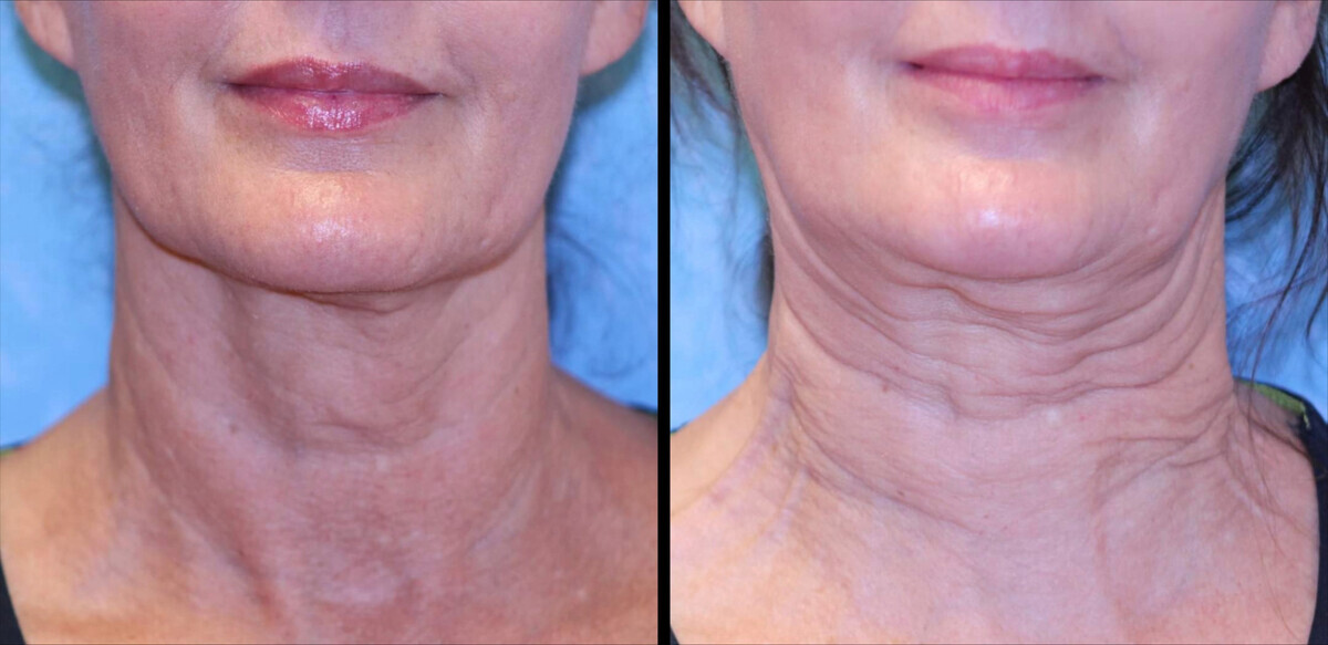Sofwave before and after — patient example 1